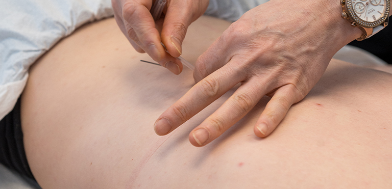 Acupuncture service in Calgary