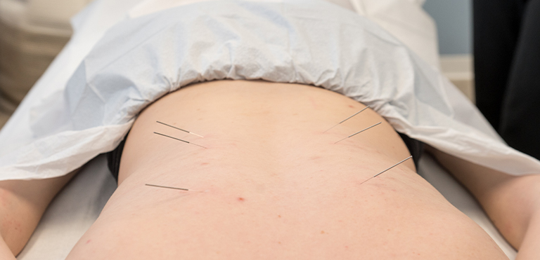 Traditional Chinese Acupuncture